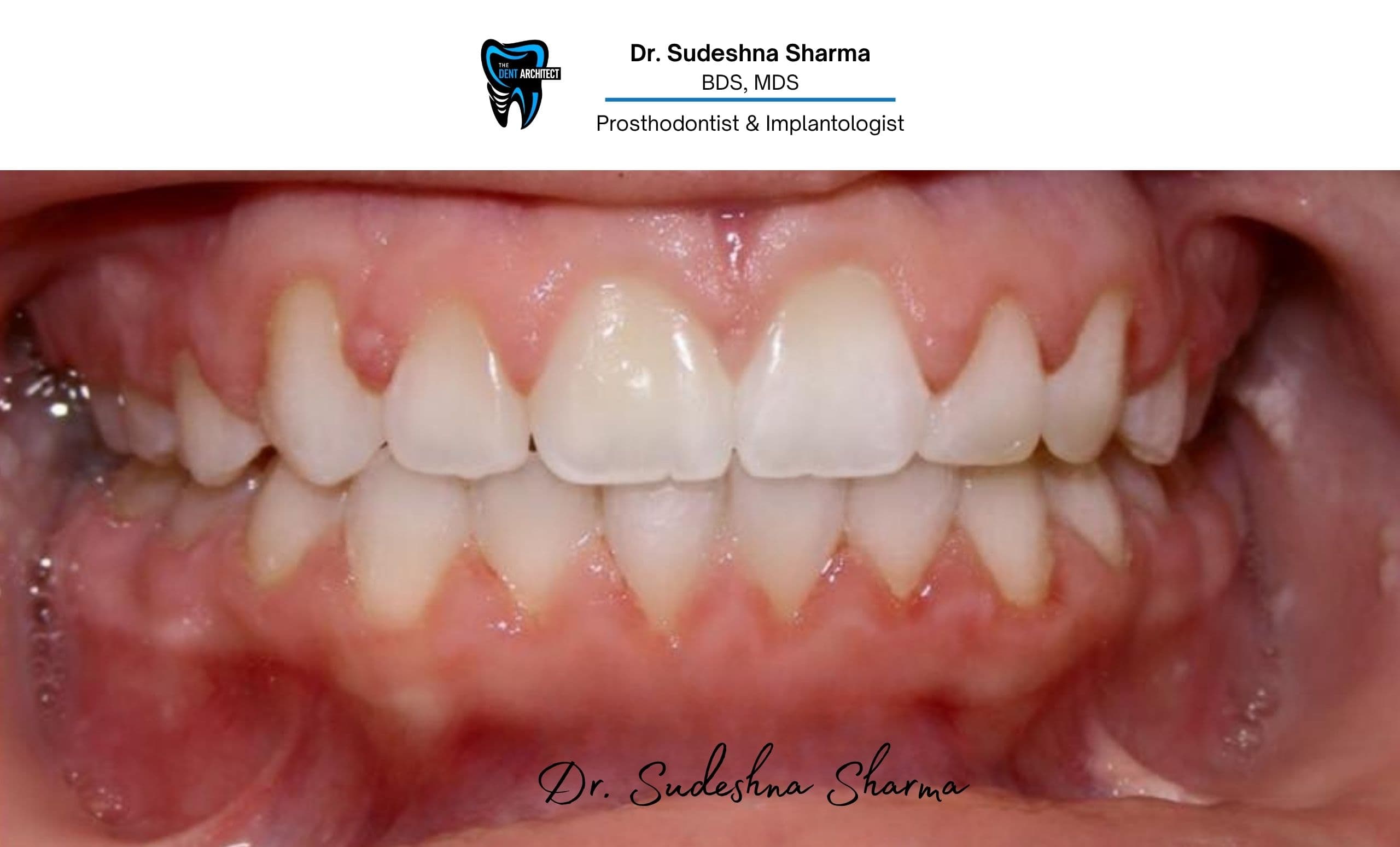 After · single implant restoration