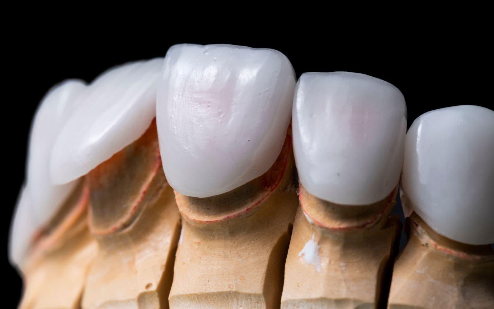 Cosmetic dentistry & veneers — photo