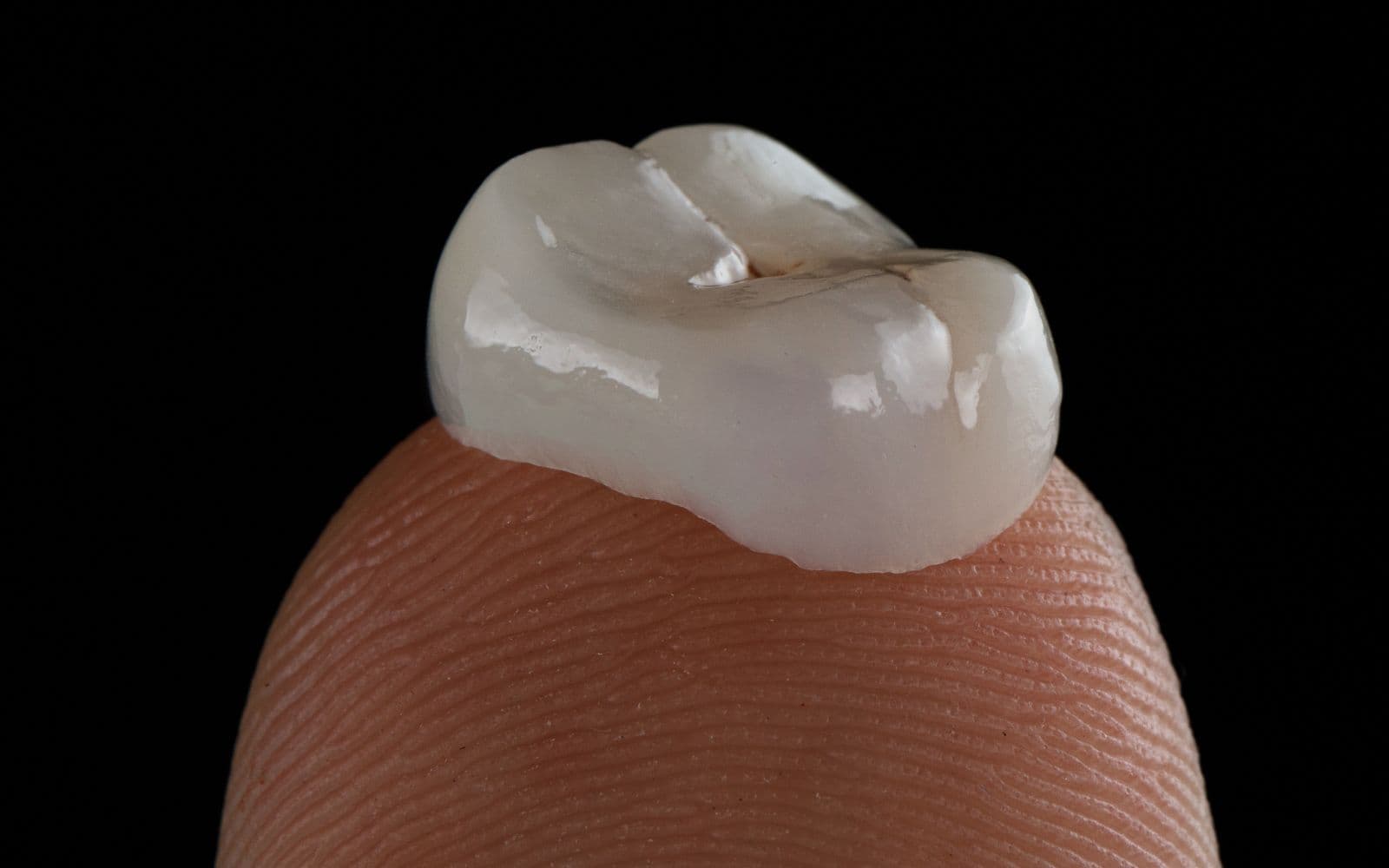 Crown & bridge — clinical photo